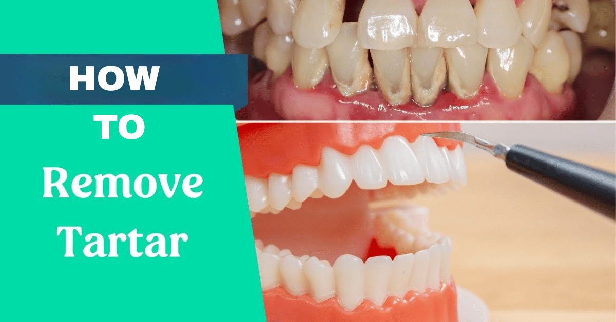 How to Remove Tartar from Teeth Without a Dentist: Effective Home Remedies