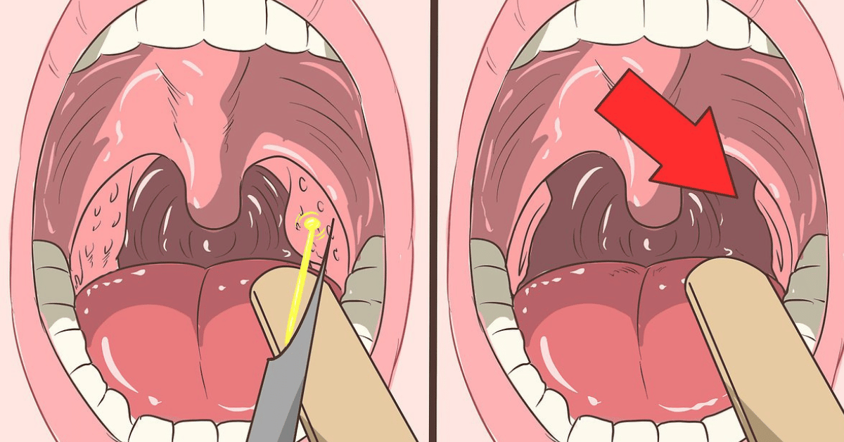 How to Remove Tonsil Stones: A Complete At-Home Guide