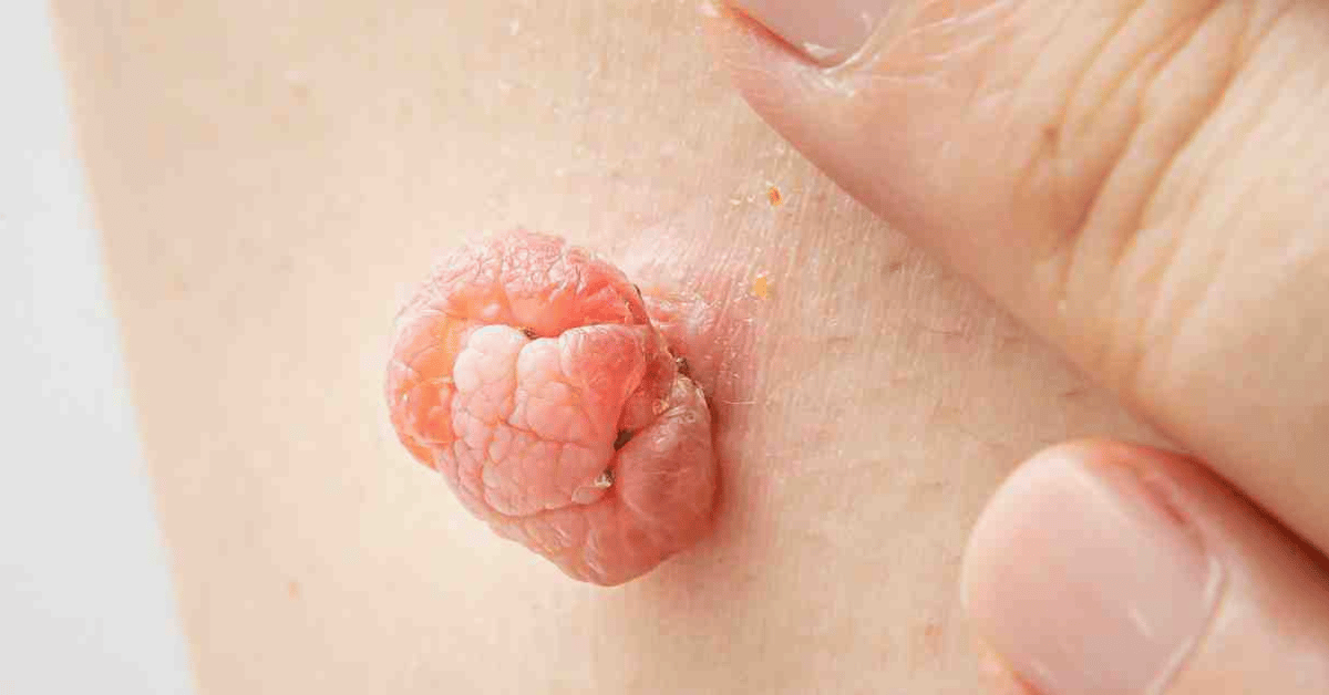 How to Remove Skin Tags in One Night: Safe and Natural Methods